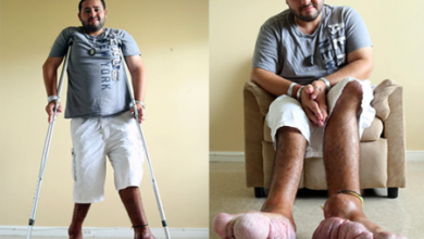 Фото - Ноги американца выросли до такого размера, что он молил врачей об ампутации