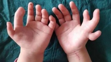 Фото - Убрали лишнее: девочке с 14 пальцами провели операцию