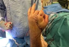 Фото - Медики пришили отпиленную циркулярной пилой кисть к паху пациента