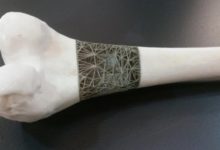 Фото - Быстро вылечить сложные переломы костей поможет 3D-печать