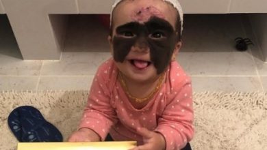 Фото - Мама американской девочки с «маской Бэтмена» показала дочь после операции в России