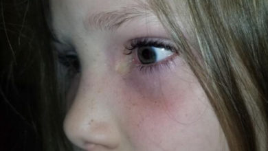 Фото - Из глаза маленькой пациентки, приехавшей в больницу, выпал жук