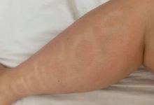 Фото - Воспользовавшись лосьоном для загара, женщина наутро проснулась с надписью на ноге