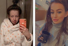 Фото - Девушка показала перемены во внешности после отказа от наркотиков