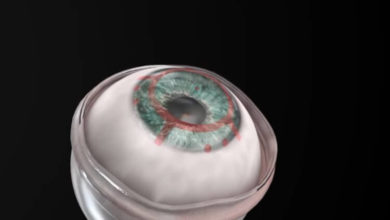 Фото - Что такое искусственная роговица глаза и зачем она нужна?