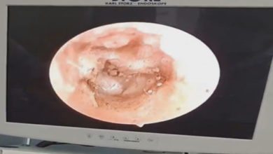 Фото - В ухе пациента, жаловавшегося на зуд, обнаружился целый рассадник «грибов»