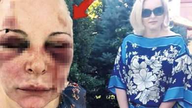 Фото - Россиянка приехала к мужчине в Турцию и сбежала через два дня избиений
