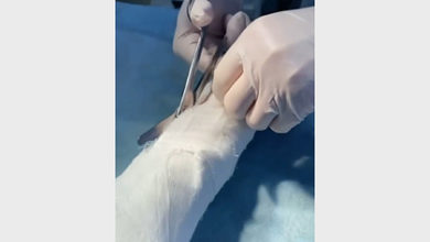 Фото - Ведущей Первого канала внутри руки поставили швейцарский имплант
