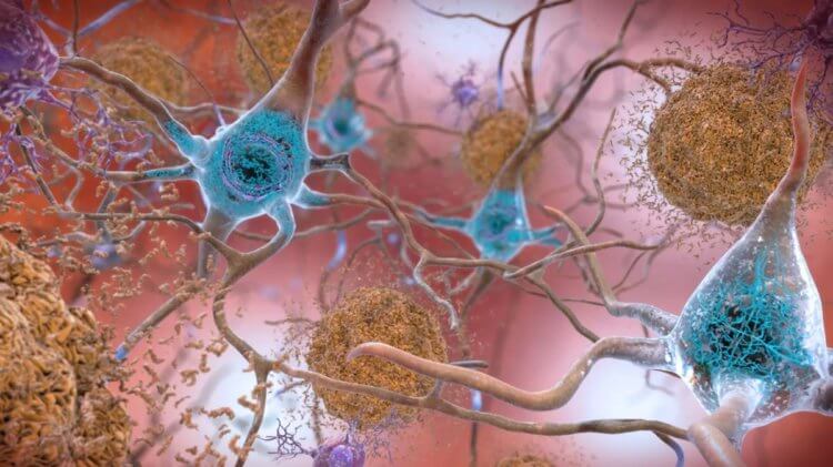 Ученые определили четыре типа болезни Альцгеймера