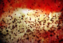 Фото - В Индии распространяется мукоромикоз – опасная грибковая инфекция. Что нужно знать?