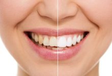 Фото - Как отбеливатели для зубов приводят к их разрушению?
