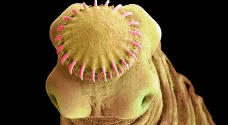В мозге здорового человека могут жить черви-паразиты и вызывать припадки