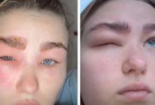 Фото - Аллергия на ламинирование бровей оказалась такой сильной, что женщина не могла открыть один глаз