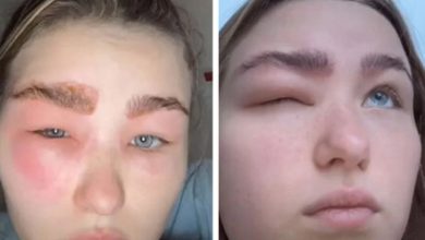Фото - Аллергия на ламинирование бровей оказалась такой сильной, что женщина не могла открыть один глаз