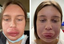Фото - Удалив филлер из губ, женщина стала жертвой сильной аллергии