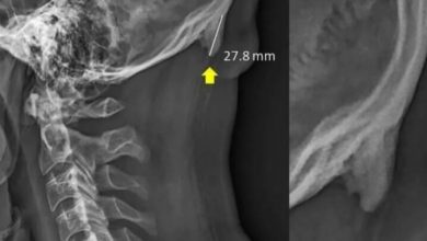 Фото - Из-за чего на шее людей растут костяные отростки?