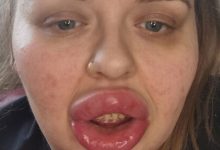 Фото - Из-за аллергии на губные филлеры женщина попала в больницу
