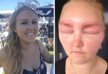 Фото - Из-за аллергии на краску для бровей женщина ослепла на сутки