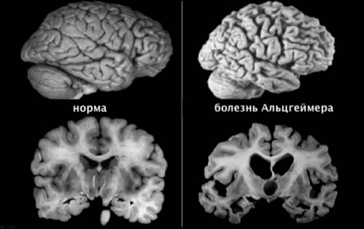 Почему женщины страдают от болезни Альцгеймера чаще, чем мужчины