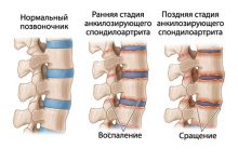 Фото - Сибирские ученые создадут тест-системы для ранней диагностики заболевания позвоночника