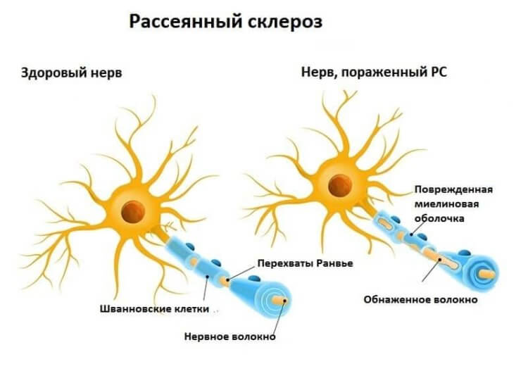 Глобальное потепление климата активизирует рассеянный склероз и утяжеляет течение болезни