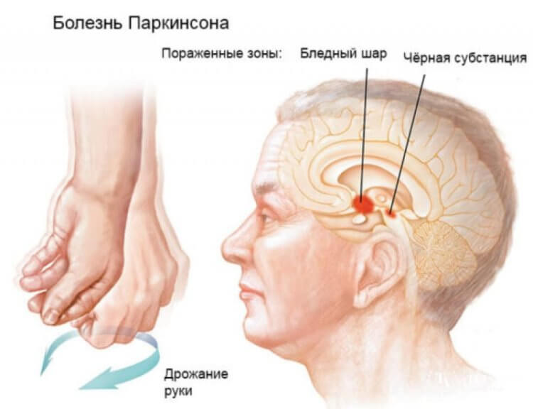 Ученые нашли способ как лечить болезнь Паркинсона — поможет в этом парфюмерная добавка