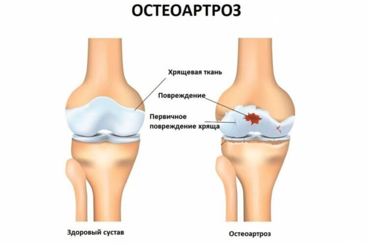 Носовой хрящ поможет восстанавливать суставы при остеоартрозе