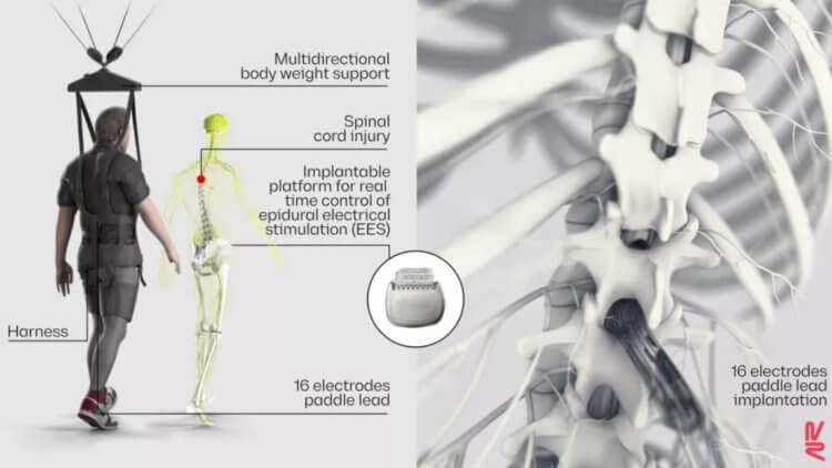 Как электрические разряды помогут парализованным людям ходить